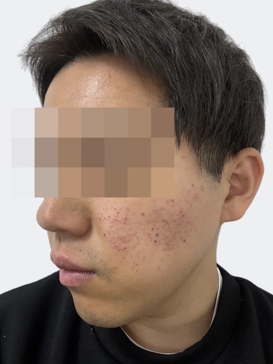 2月22日の左頬