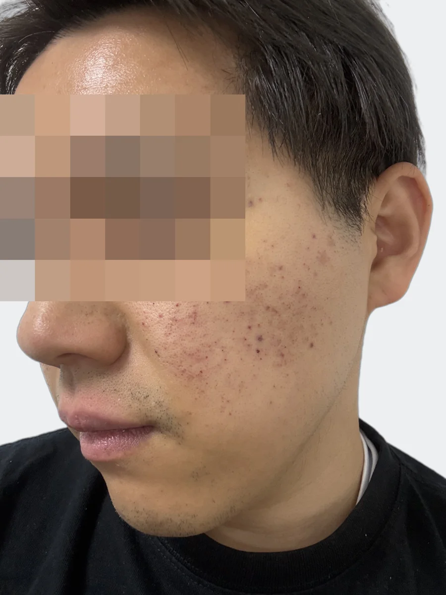 2月23日の左頬