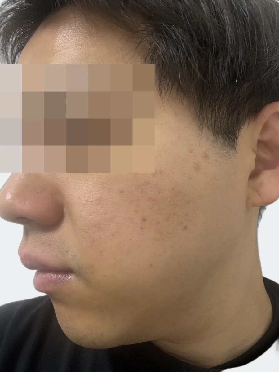2月28日の左頬