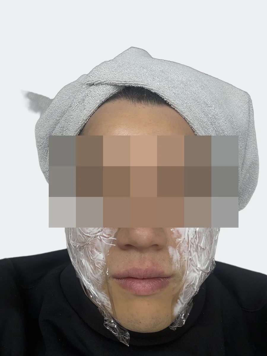 麻酔クリームを両頬に塗った状態