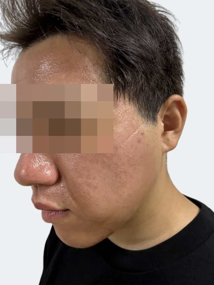 30分後の左頬
