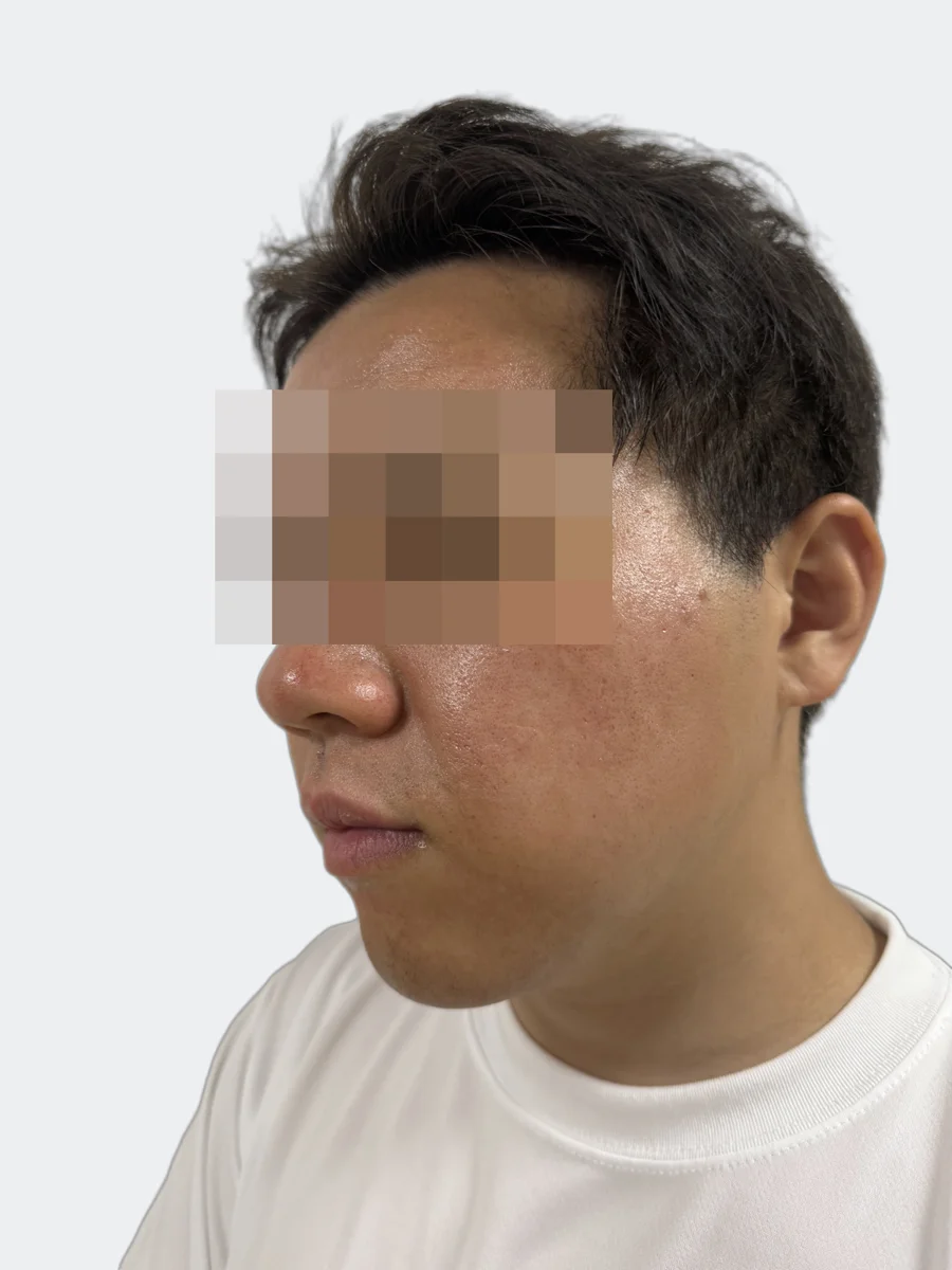 4時間後の左頬