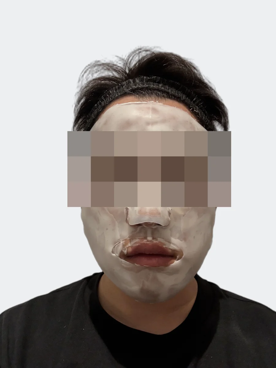 麻酔クリームを顔全体に塗った状態