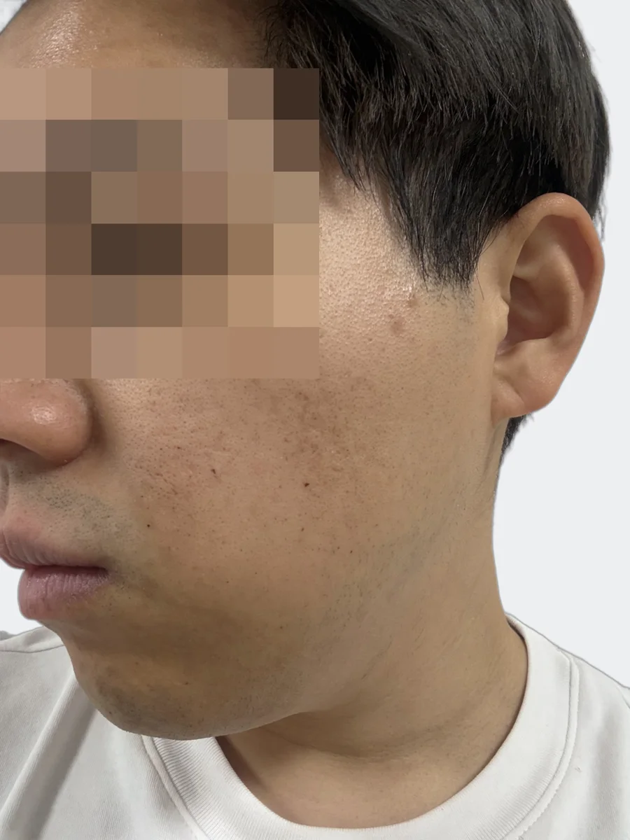 24時間後の左頬