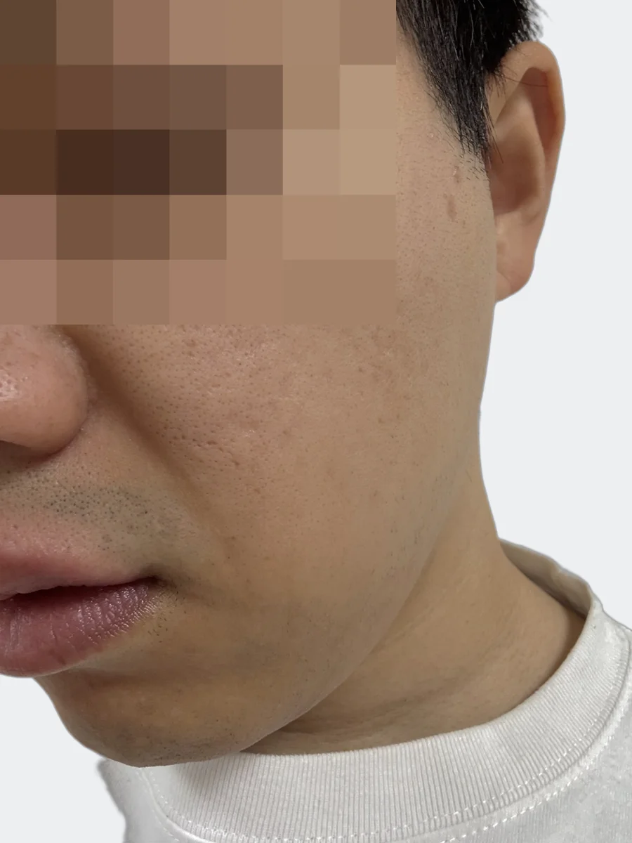 施術前の左頬