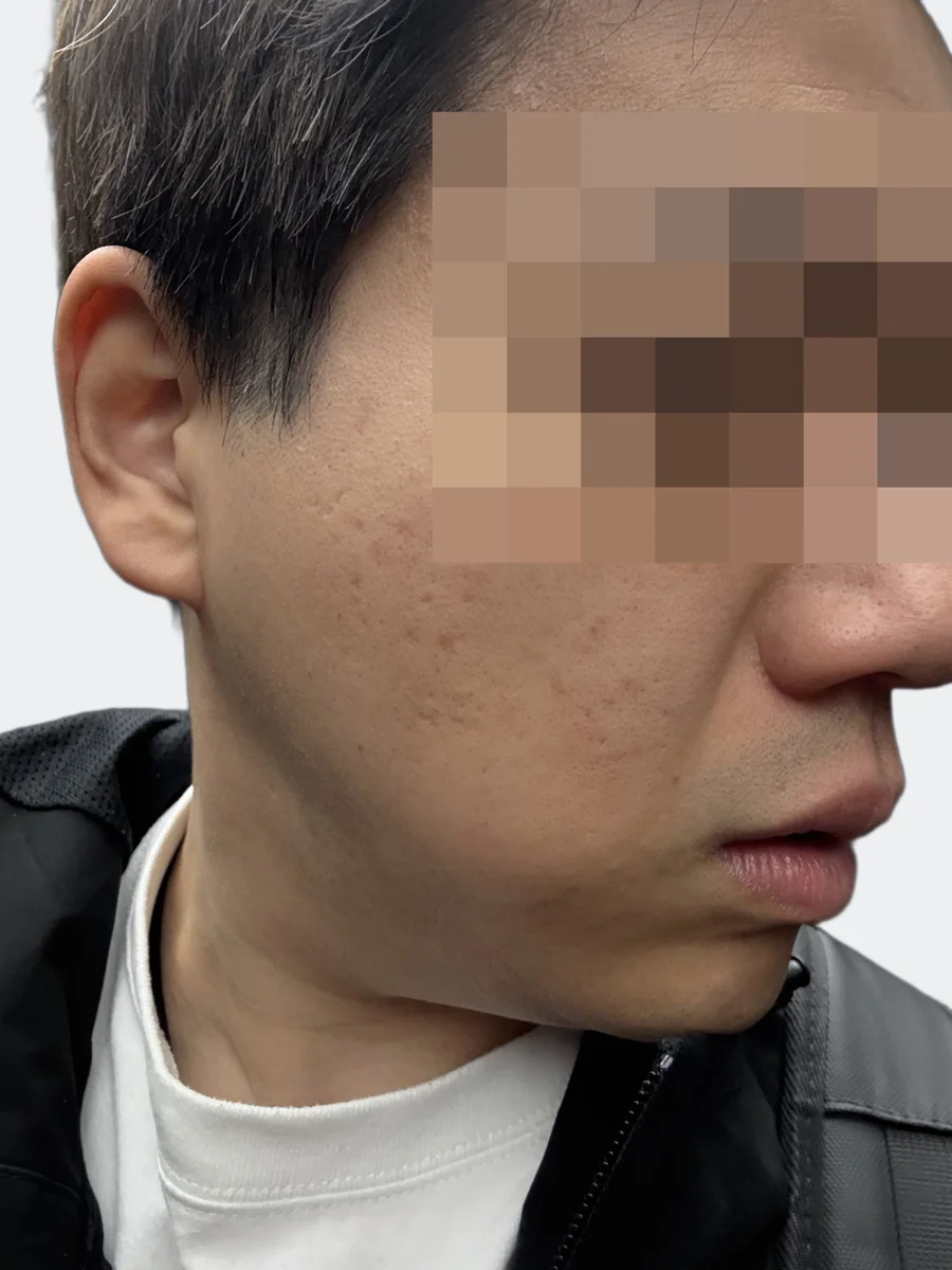 施術前の右頬