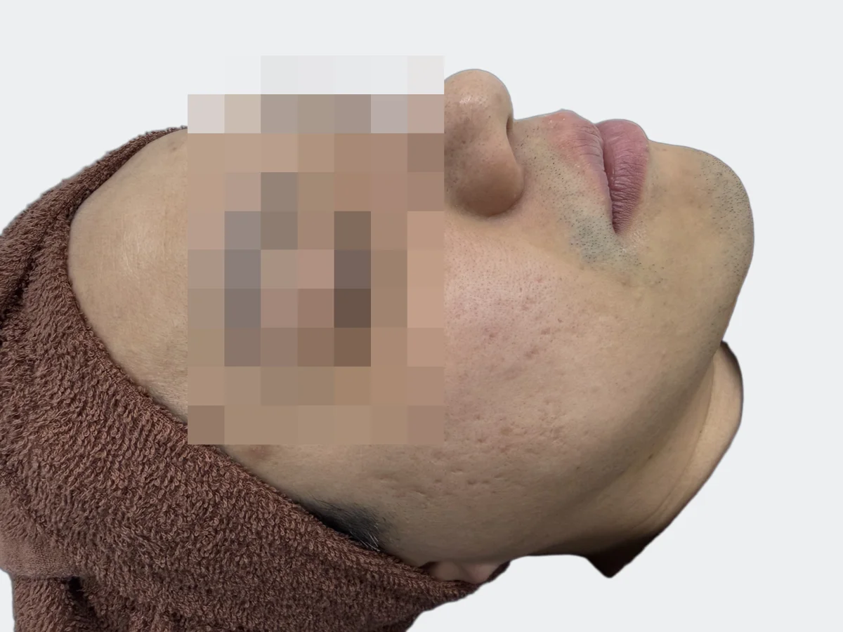 施術前の右頬