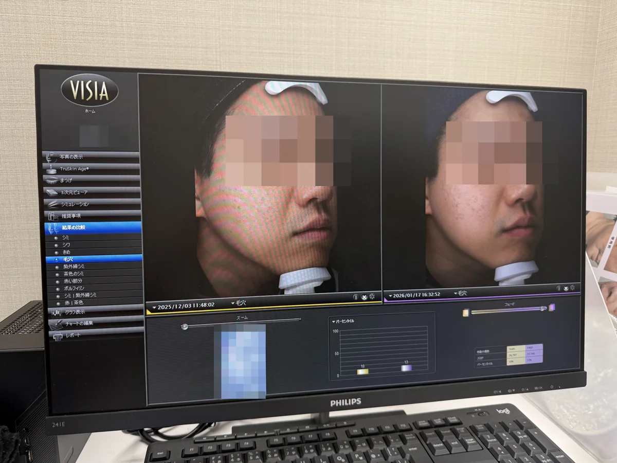 VISIAの画面で毛穴を1回目と比べたところ