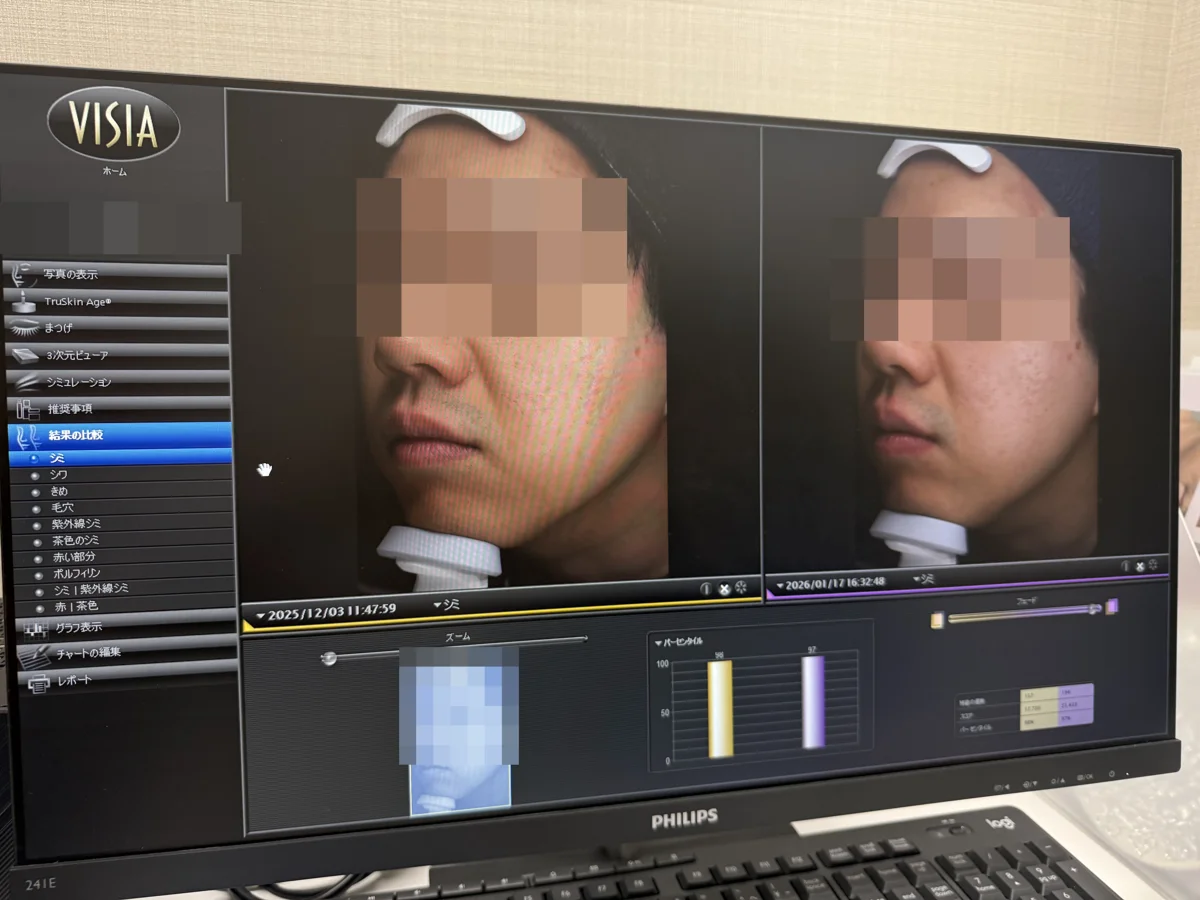 VISIAの画面でシミを1回目と比べたところ