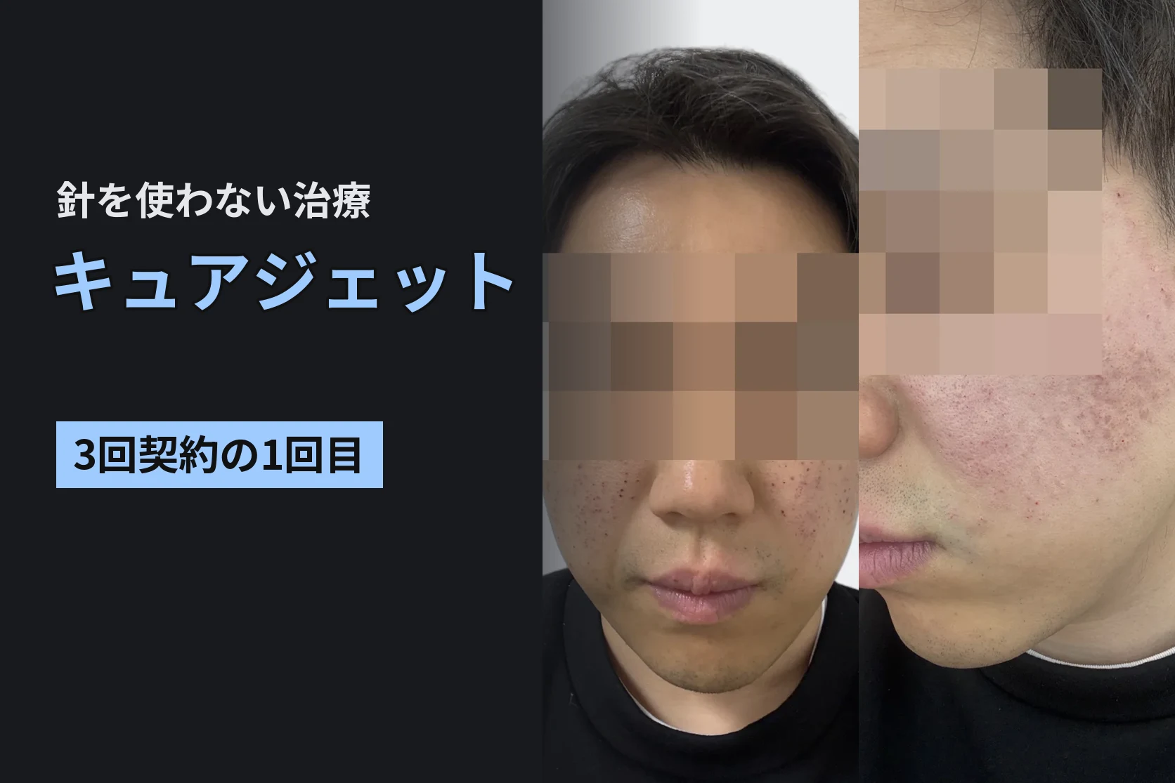 エリシスセンスをやめて、キュアジェットだけに。3回契約の1回目を受けてきた