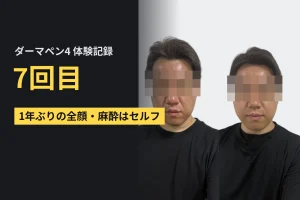 ニキビ跡は改善される!? ダーマペン4の体験記録 7回目
