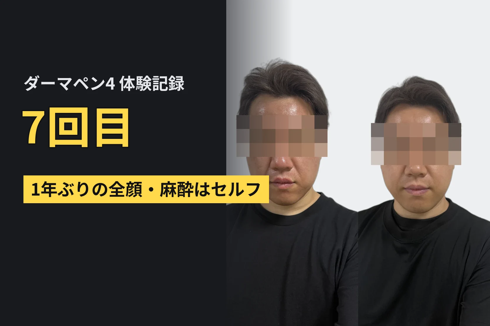 ニキビ跡は改善される!? ダーマペン4の体験記録 7回目