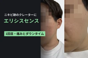 ダーマペンの次はエリシスセンス。ニキビ跡のクレーターに1回目を受けてきた