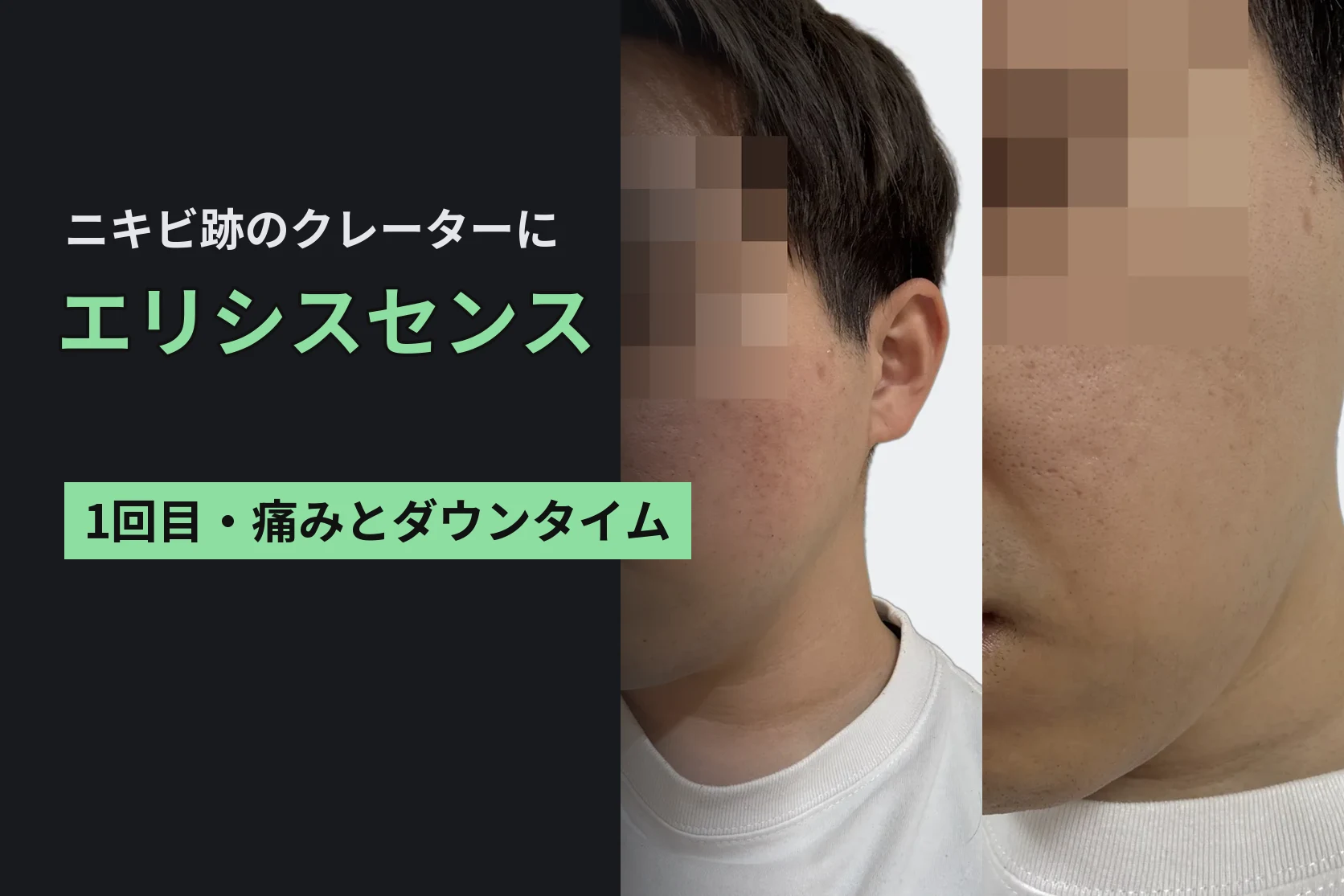 ダーマペンの次はエリシスセンス。ニキビ跡のクレーターに1回目を受けてきた
