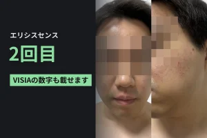 エリシスセンス2回目。キュアジェットはコンタクトに変えて、VISIAで1回目と比べた