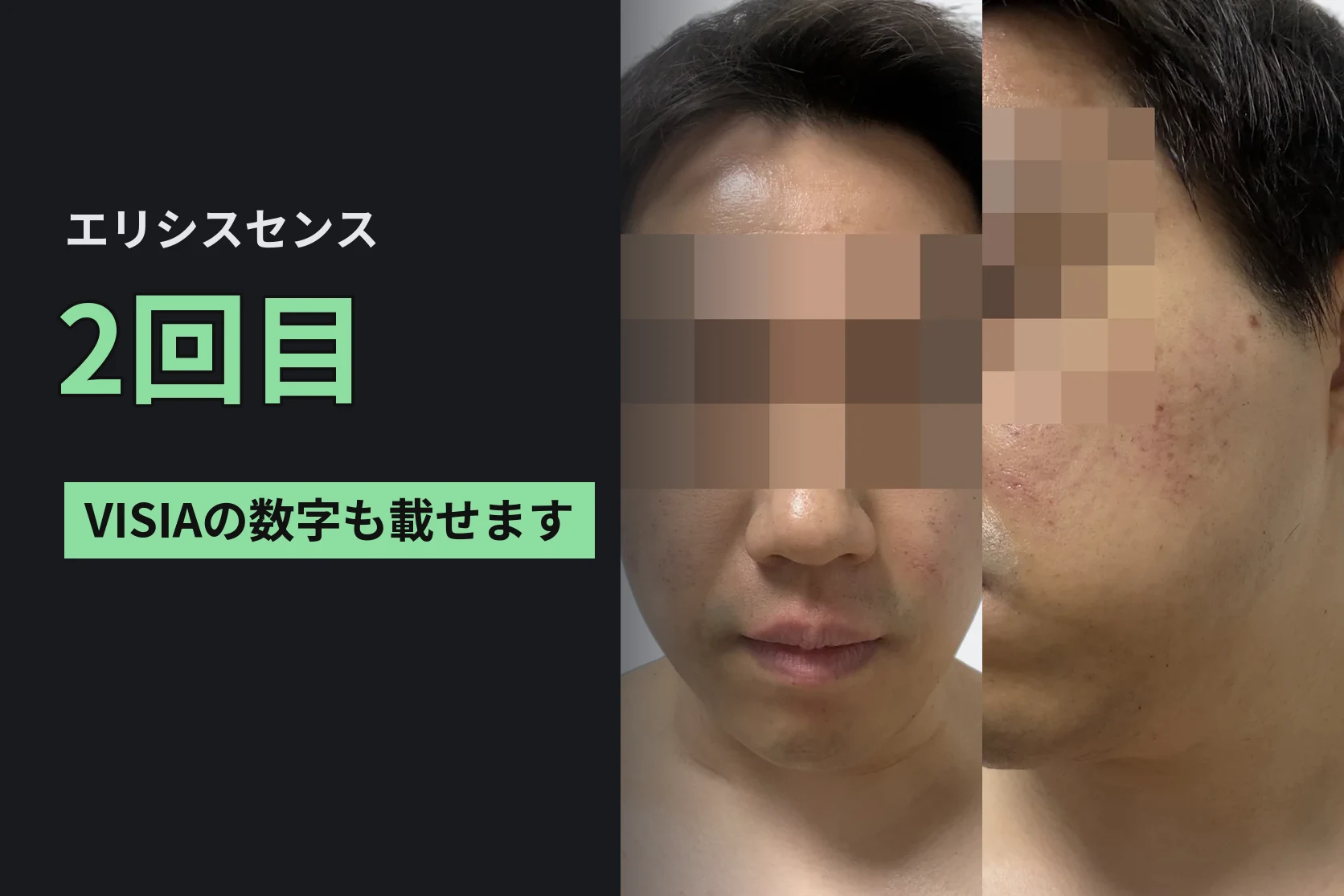 エリシスセンス2回目。キュアジェットはコンタクトに変えて、VISIAで1回目と比べた