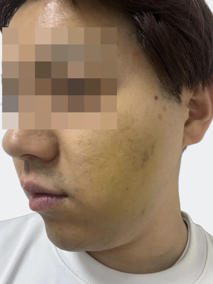 4月17日の左頬