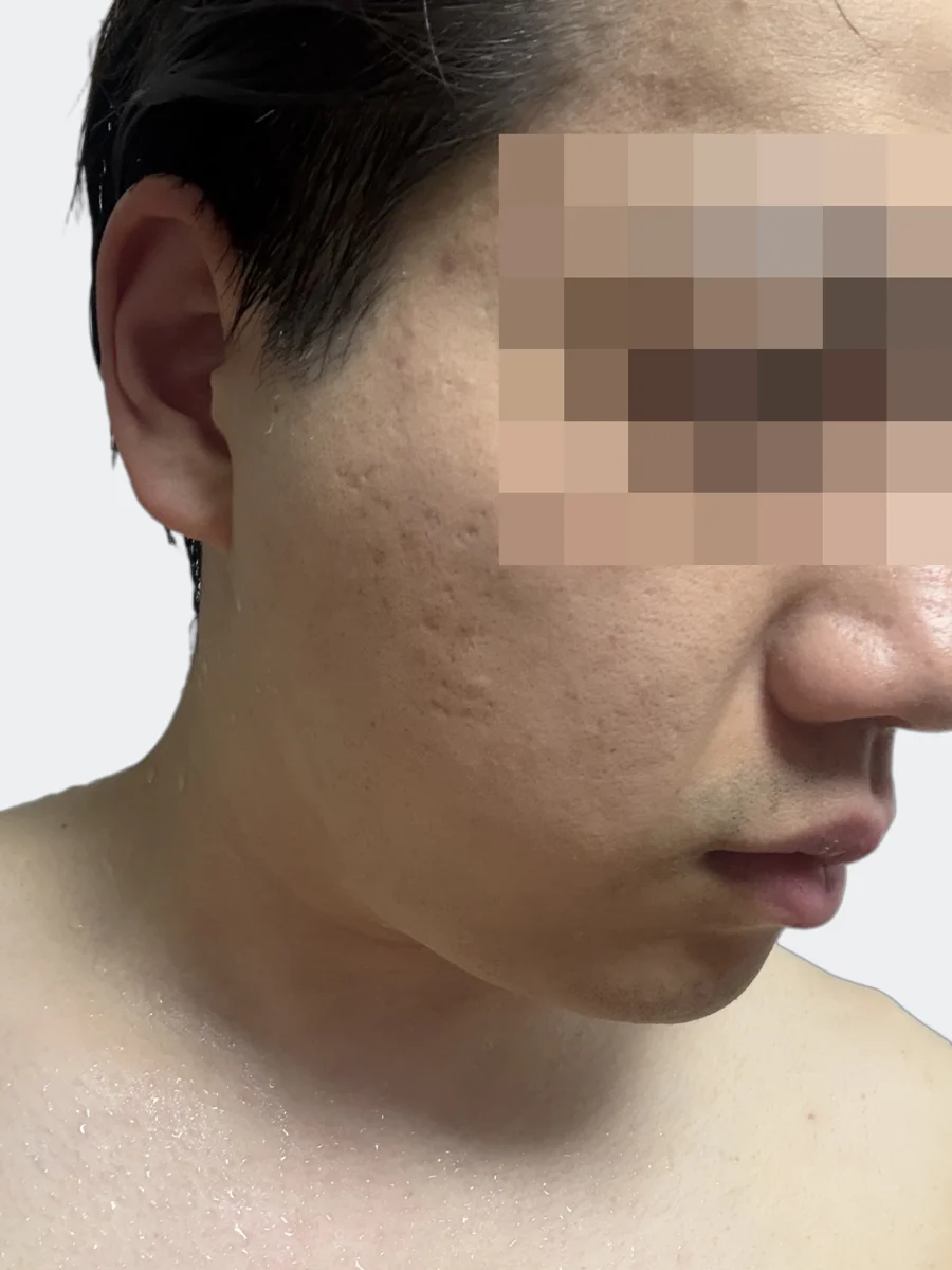 約1か月後の右頬