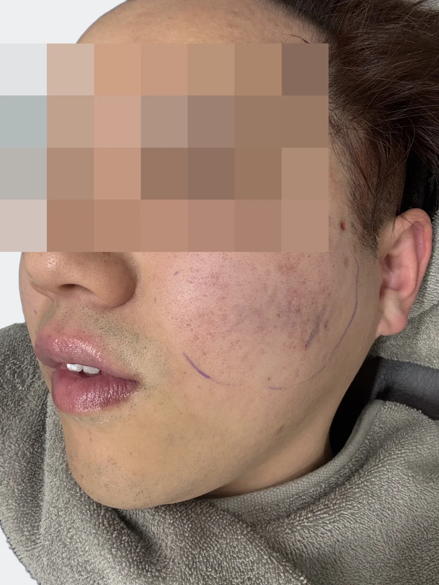 頬に施術範囲の線を引いた状態